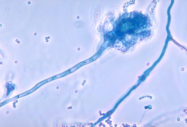 Trichomoniasis