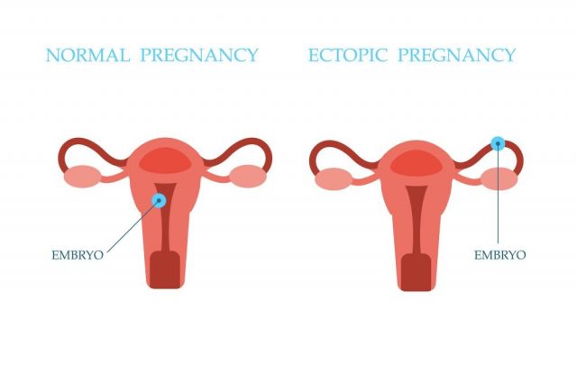 Ectopic Pregnancy and Normal Pregnancy