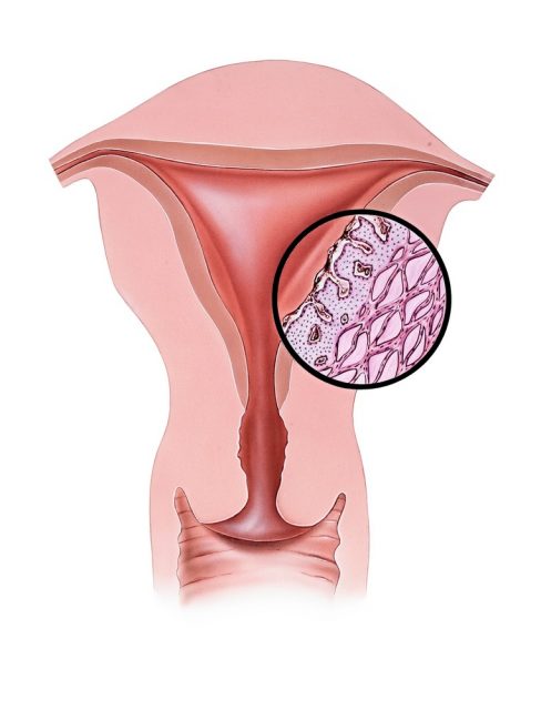 Conceptual illustration of dysmenorrhea (menstrual pain)