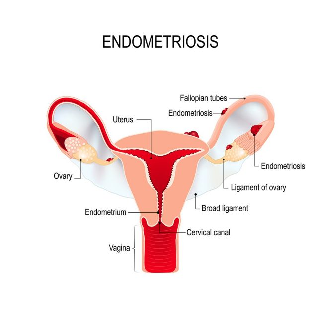 Endometriosis