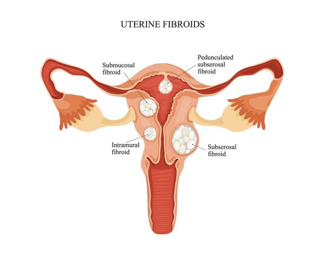 Fibroids in Uterus