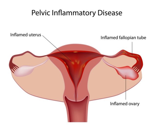 Pelvic Inflammatory Disease (PID)