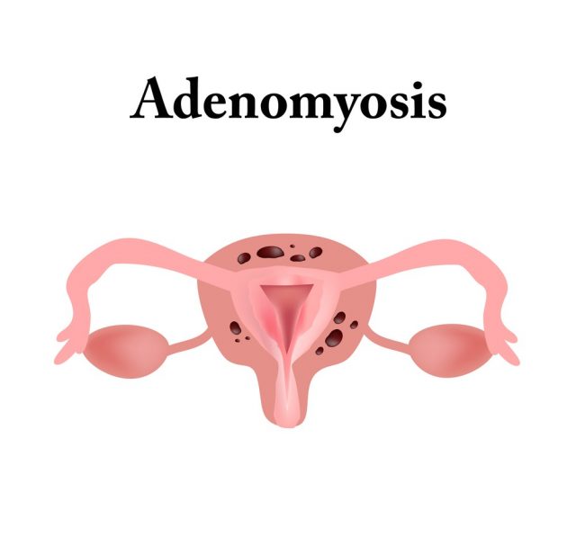 Adenomyosis