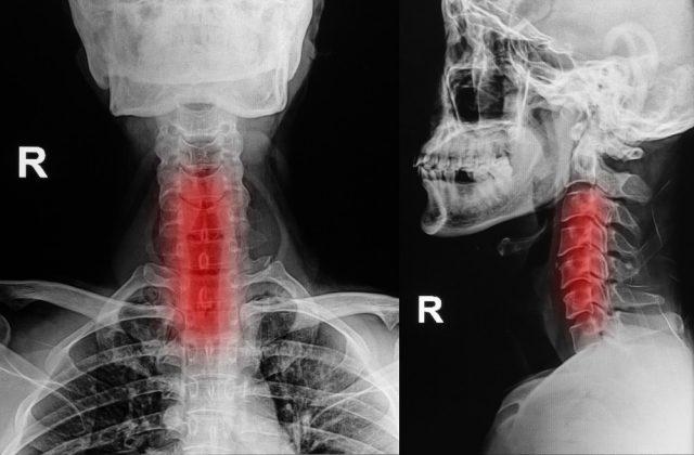 Cervical Stenosis