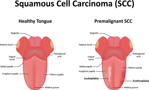 Why Is My Tongue White: Leukoplakia