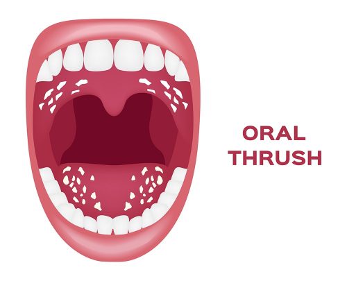 Why Is My Tongue White: Oral Thrush