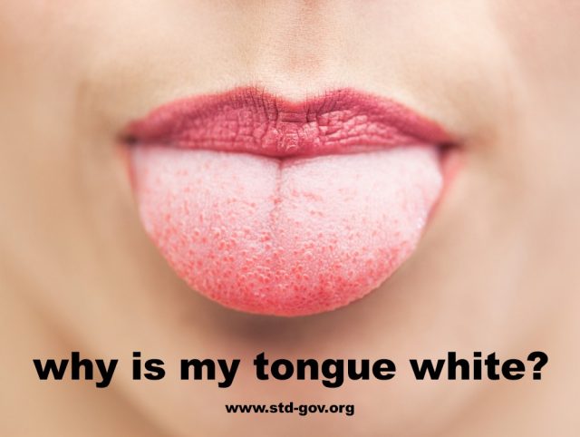 Why Is My Tongue White?