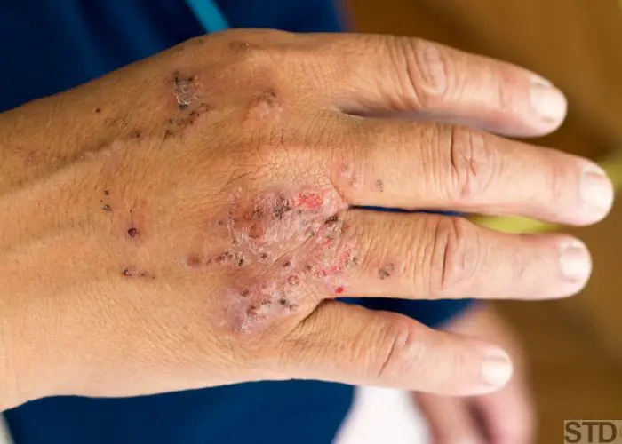 Dermatitis infection after ant bite