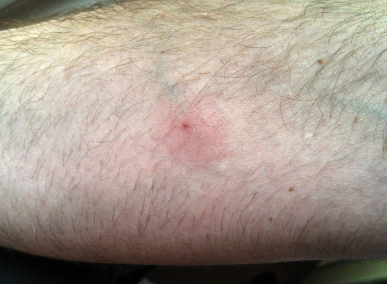 Red Ant Bite Treatment