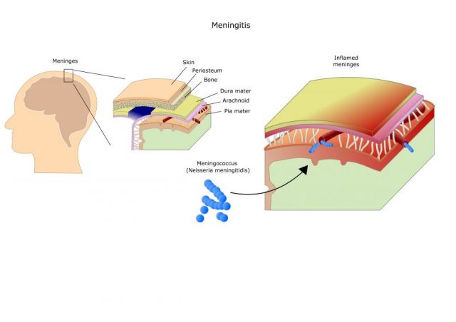 meningitis: inflammation (bacteria, viruses, fungi) of the meninges. Mainly by Neisseria meningitidis (meningococcus)