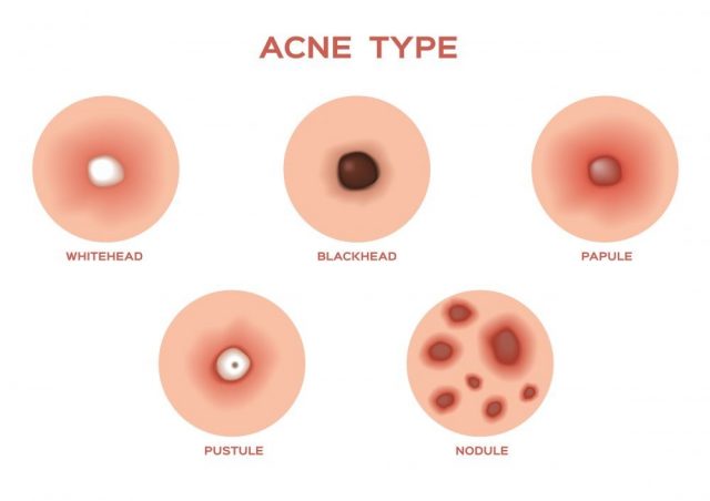 Types of Acne and Pimples