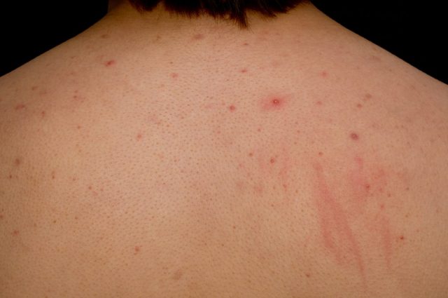 Acne on a males back