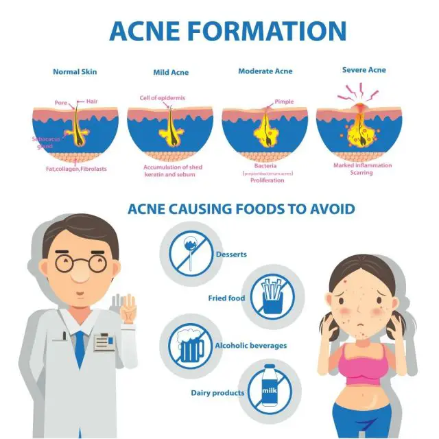 Acne formation Info Graphic and diagrams