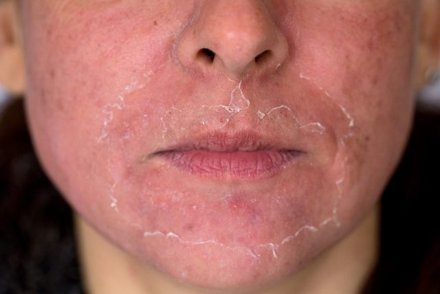 Front view of caucasian woman face after chemical peeling