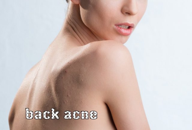 Back Acne