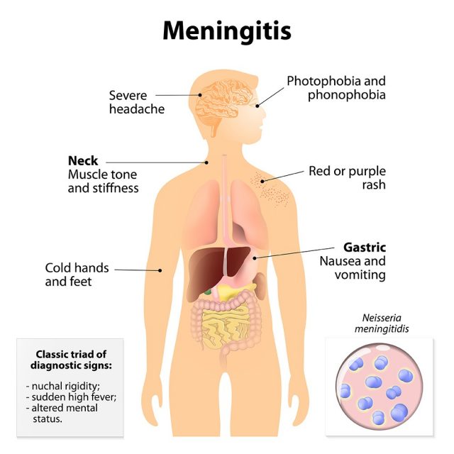 Meningitis. Signs and symptoms. Human silhouette with internal organs