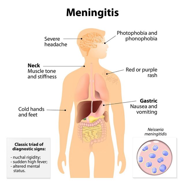 Meningitis. Signs and symptoms. Human silhouette with internal organs