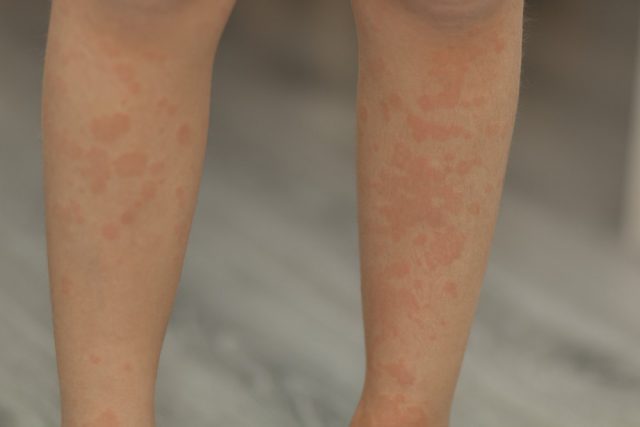 The child sick with measles. Red spots all over my body. Legs, arms, back, stomach