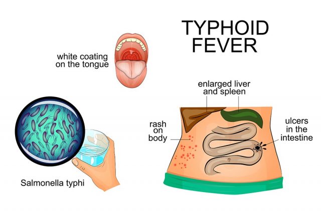 illustration of typhoid fever. infographics. pathogen. symptoms