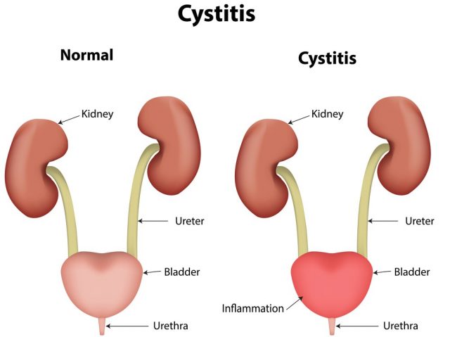 Cystitis, Urinary Tract Infection