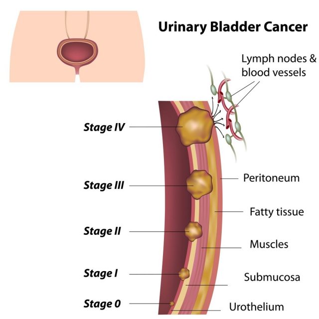Stages of urinary bladder cancer