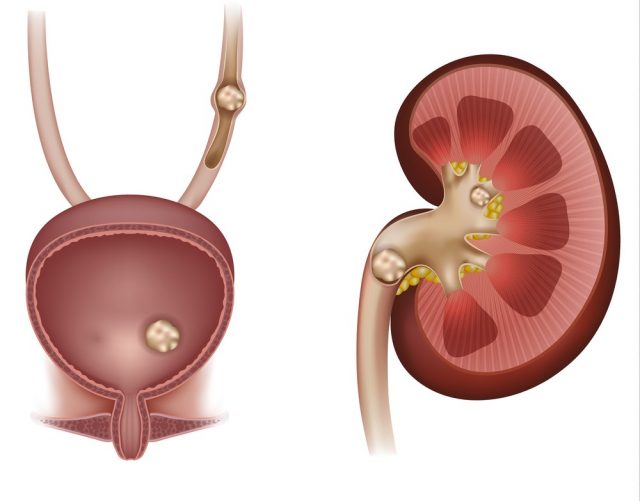 Stones in the kidney, urinary bladder and ureter. Detailed anatomy illustration of the kidney cross section and urinary bladder cross section