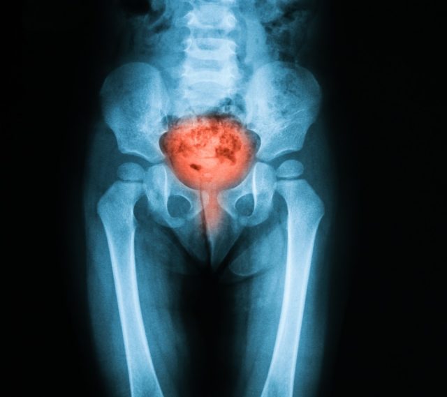 X-ray image of bladder, Showing cystitis or lower urinary tract infection