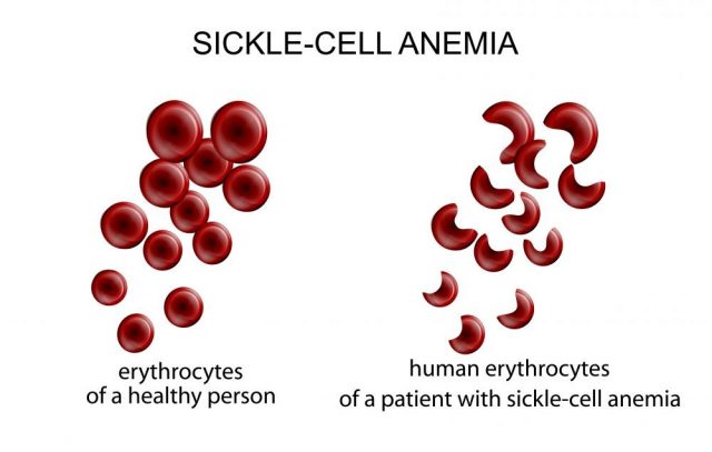 illustration of blood cells in the disease sickle-cell anemia