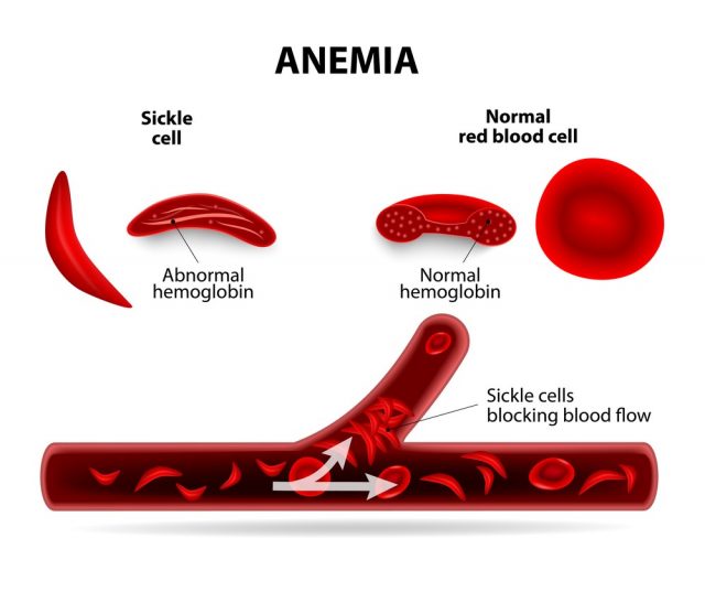 anemia. sickle cell and normal red blood cell