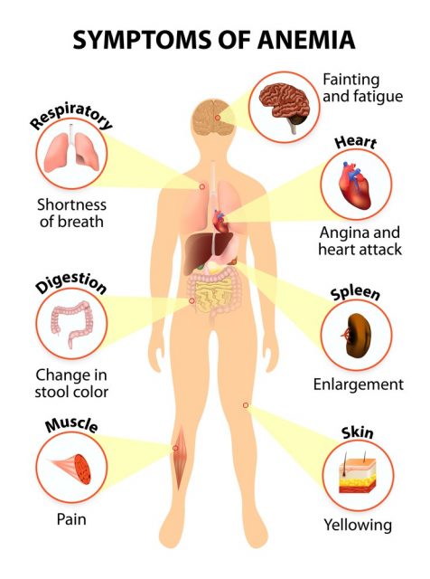 Main sign and symptoms that may appear in anemia