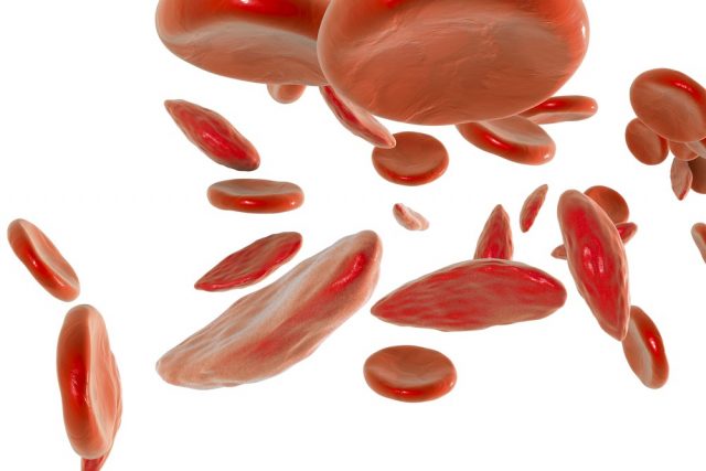 Sickle cell anemia, 3D illustration showing normal and deformated crescent-like red blood cells
