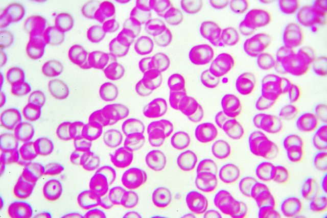 Abnormal red blood cells in anemia patient