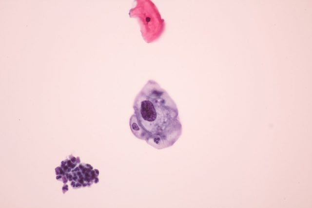 View in microscopic of koilocyte cell criteria of HPV infection.Pap smear for woman