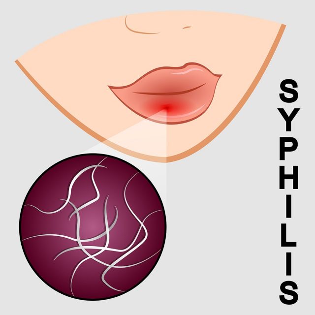 Illustration of syphilis. symptoms and causative agent
