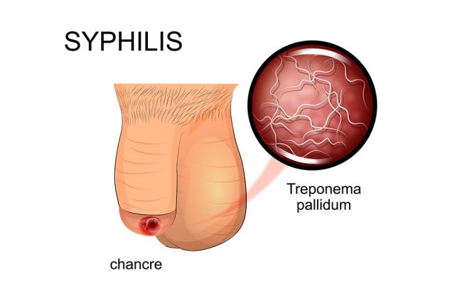 Chancre: Syphilis symptoms, affected penis