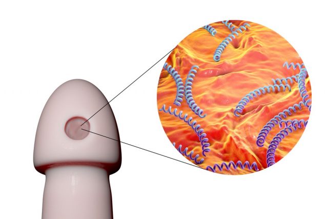 Chancre: Syphilitic ulcer