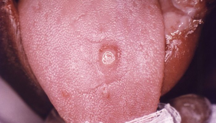 Primary stage syphilis sore (chancre) on the surface of a tongue