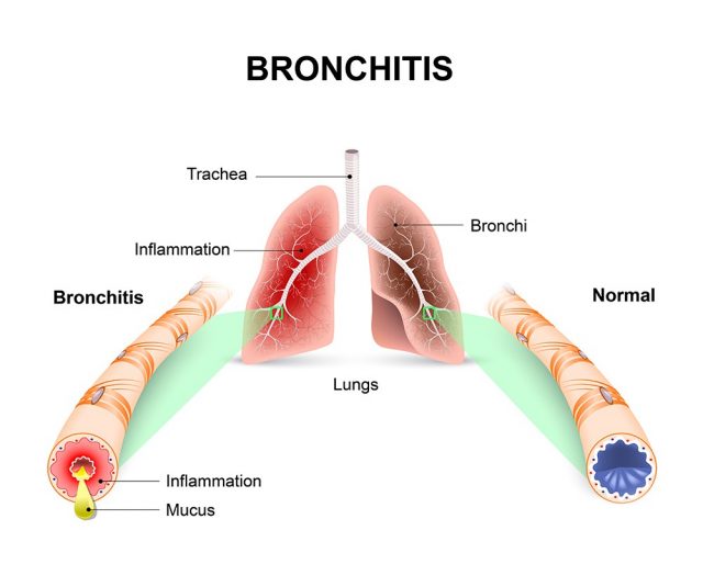 Bronchitis. Lungs and bronchial tubes. normal bronchial tube and a bronchial tube with bronchitis. 