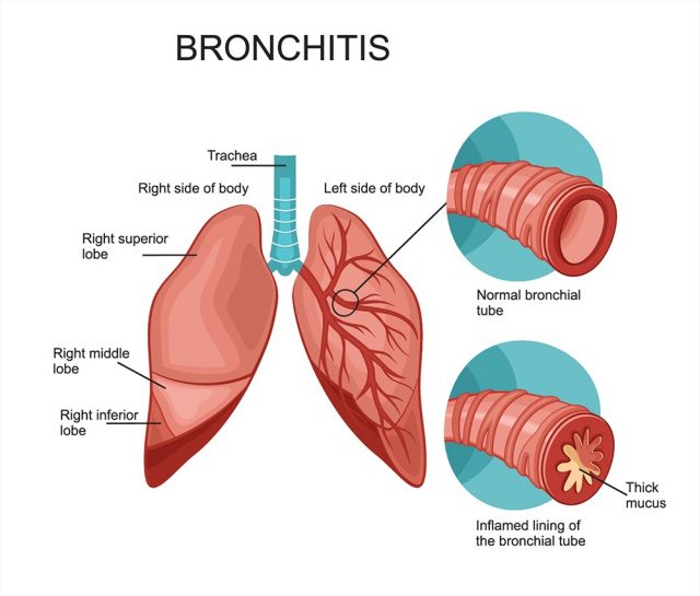 Bronchitis anatomy