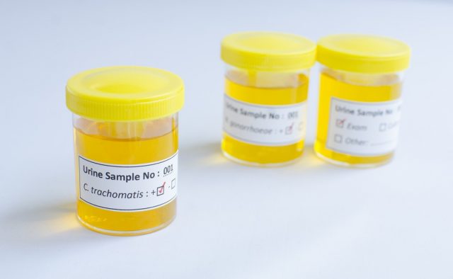 Urine sample positive with Chlamydia trachomatis bacteria
