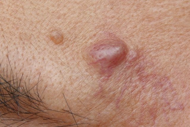 Close-up cyst on a human face