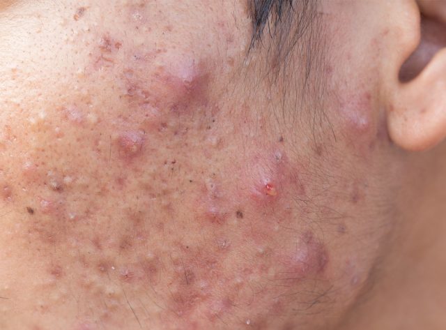 Man with problematic skin and scars from cystic acne (scar)