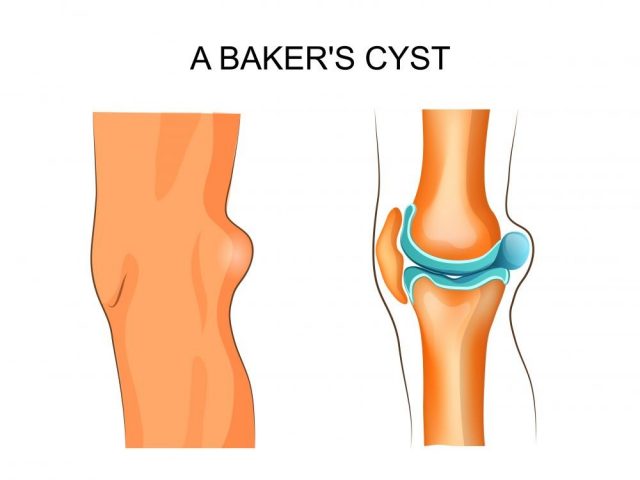 vector illustration of Baker's cyst. traumatology and orthopedics