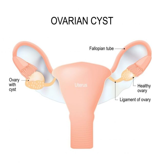 Ovarian cyst is sacs filled with fluid located on ovary