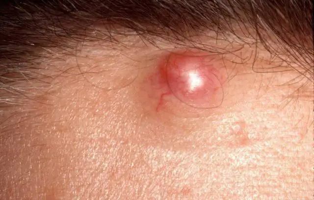 Epidermoid Cyst