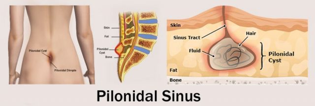 Pilonidal Sinus Cyst