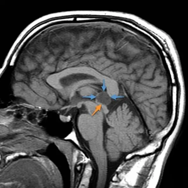 Pineal Cyst