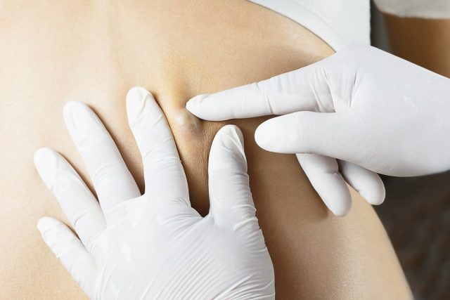 Doctor Diagnosis of the Sebaceous on Woman's Back