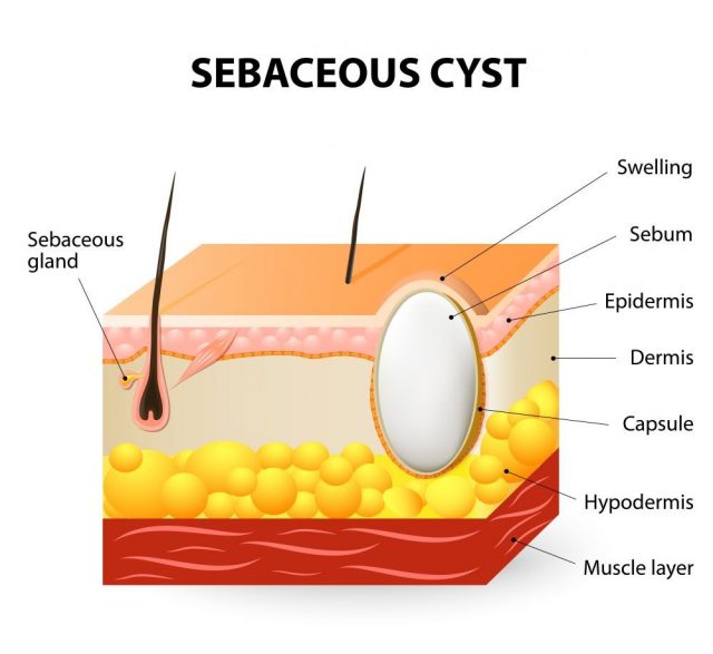 Sebaceous cysts or trichilemmal cyst. Schematic illustration of a segment of skin with Sebaceous cyst