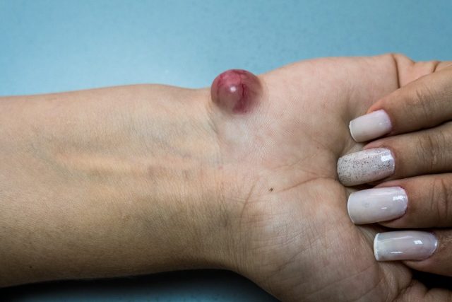 Ganglion cyst